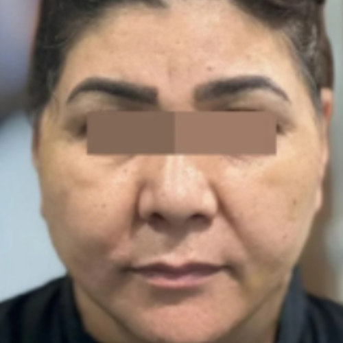 Face Lift After