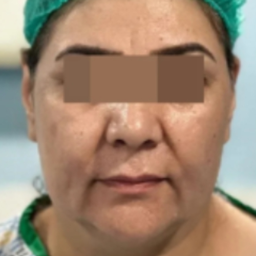 Face Lift Before