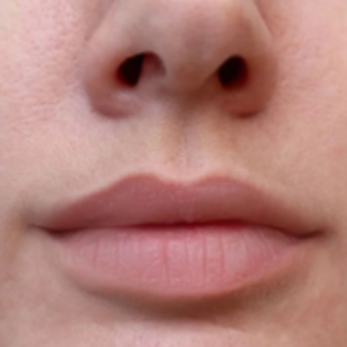 Lip Filler After