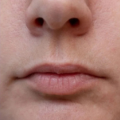 Lip Filler Before