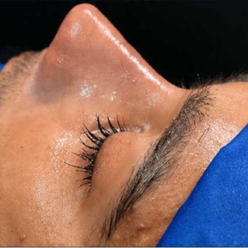 Rhinoplasty after