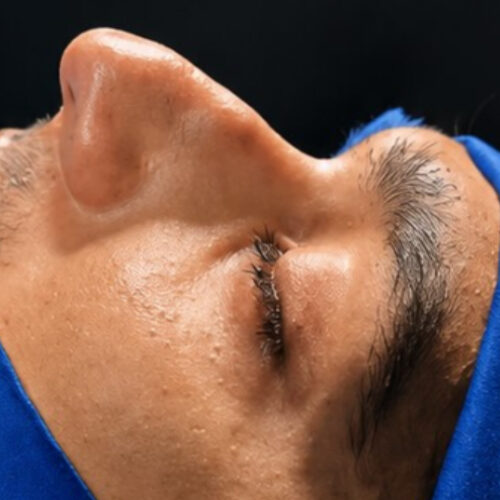 Rhinoplasty before